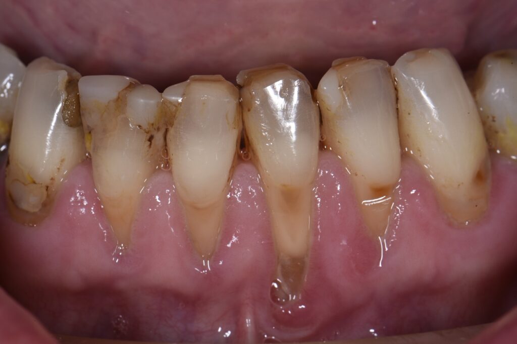 extensive-class-v-restorations-ahead-of-freehand-direct-coronal