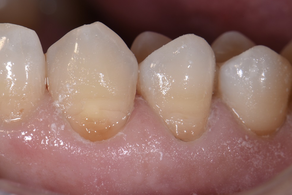 class-v-seamless-bonded-restorations