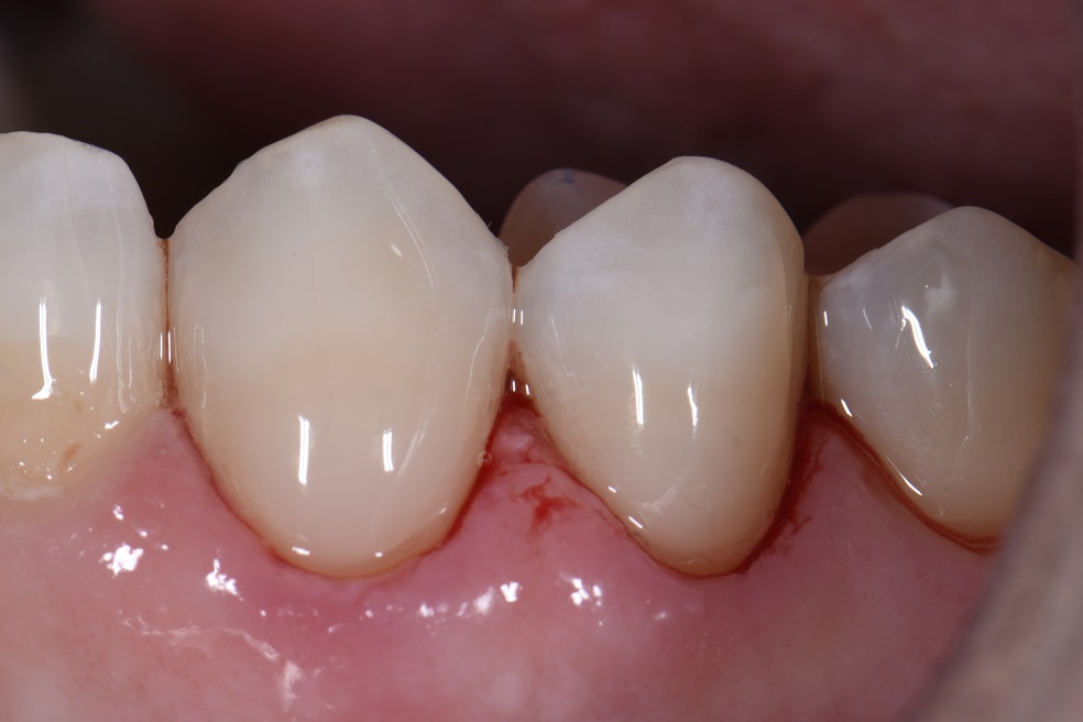 class-v-seamless-bonded-restorations