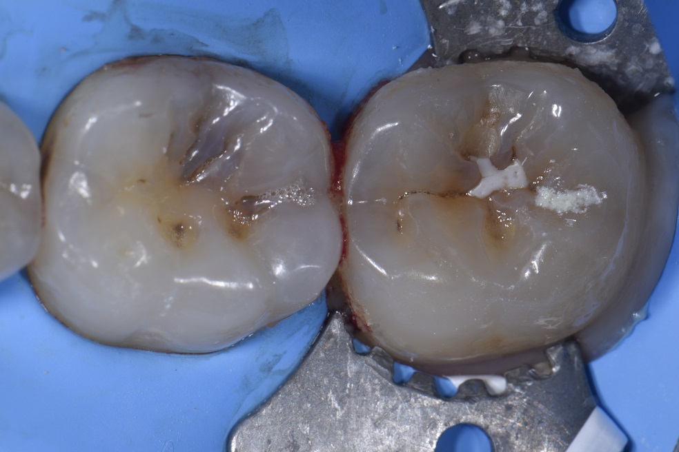 Conservative Preparations for Occlusal Caries