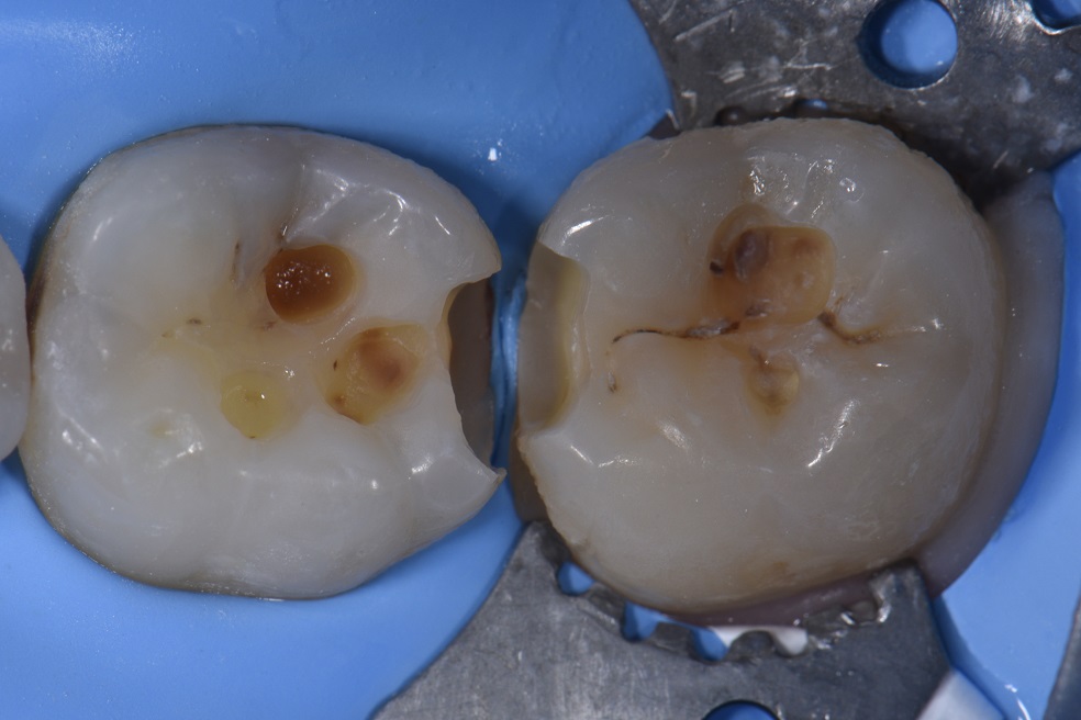 Conservative Preparations for Occlusal Caries