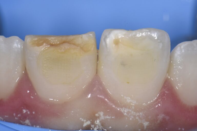 Composite Veneer and Bonding to Rectify Incisor Hypomineralization