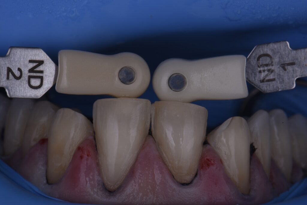 Veneer Preparations And Provisionalization Temporization