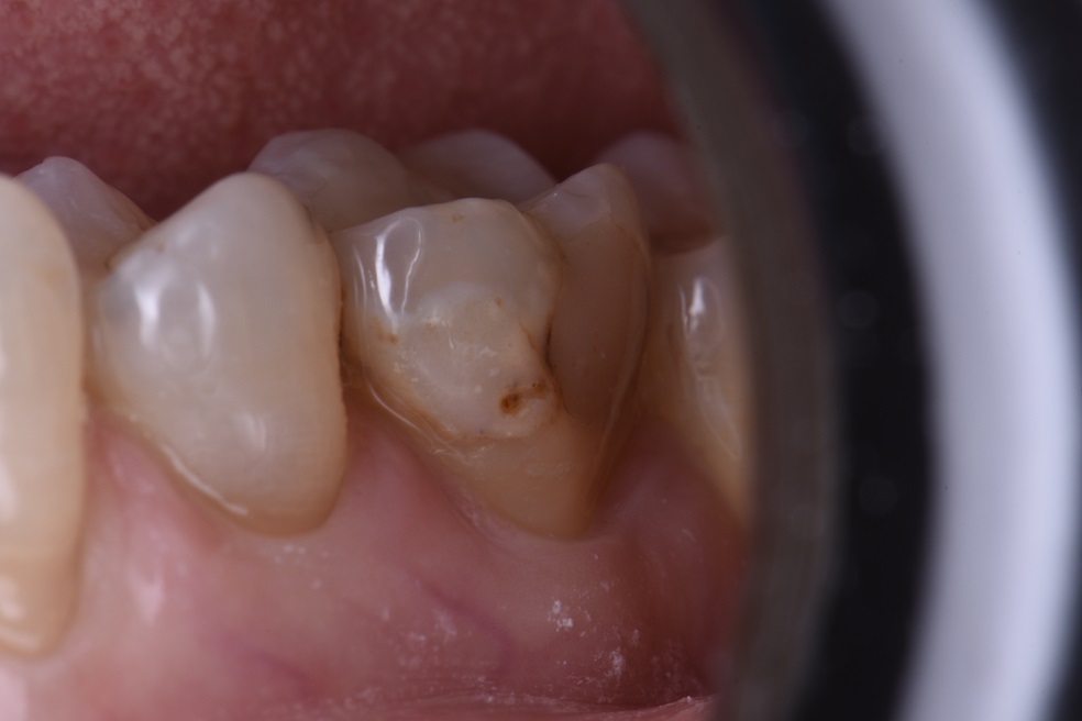 Deep buccal recurrent caries