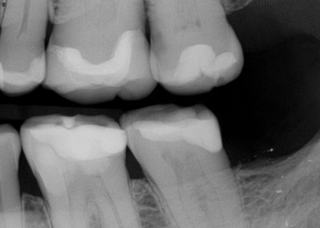 Deep Margin Elevation in Restorative Dentistry