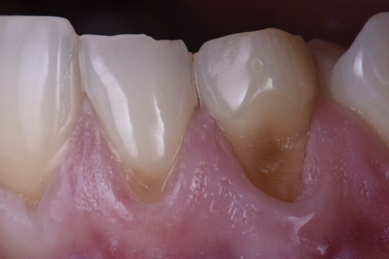 GC Gaenial Achord Partial Composite Veneer