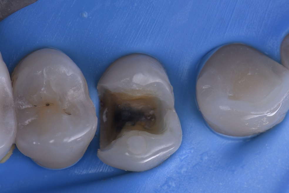 Restoring Marginal Failure on this First Premolar