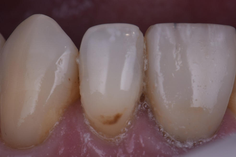 incipient-caries-removal-and-invisible-restoration