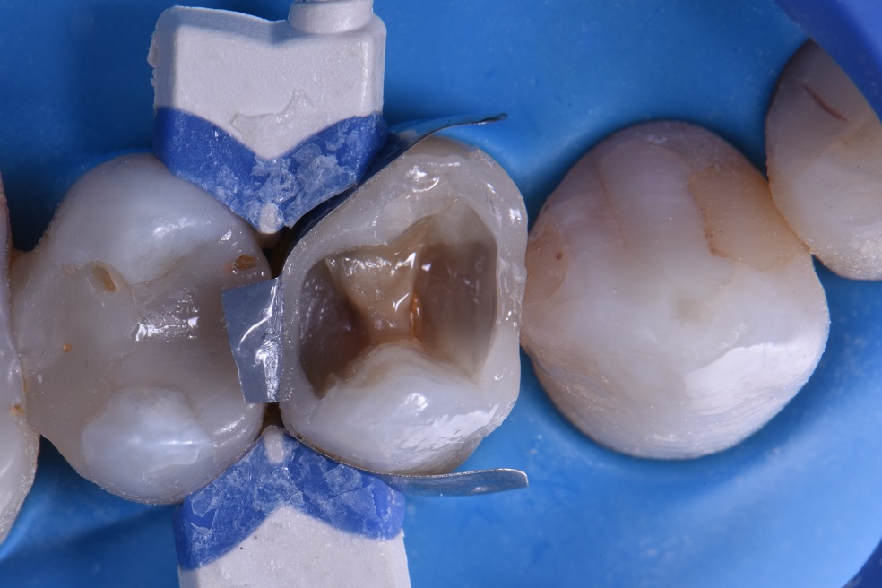 Premolar Extensive Caries With Well Blended Composite Restoration