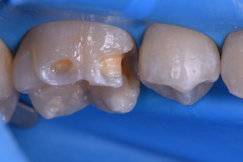 Treating secondary decay on a hypomineralized molar Treating secondary ...