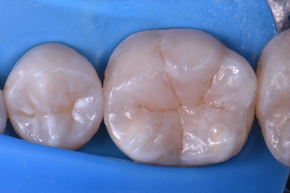 Treating secondary decay on a hypomineralized molar Treating secondary ...