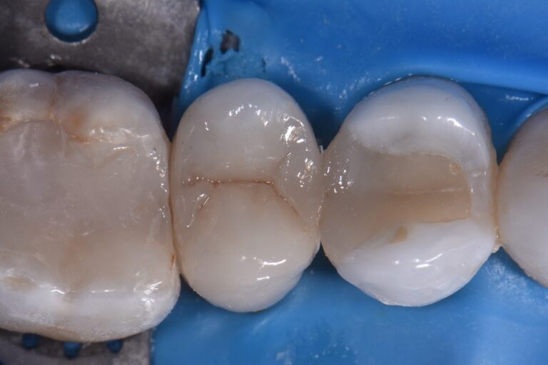 Premolar Composite Onlays and Overlays Premolar Composite Onlays and ...