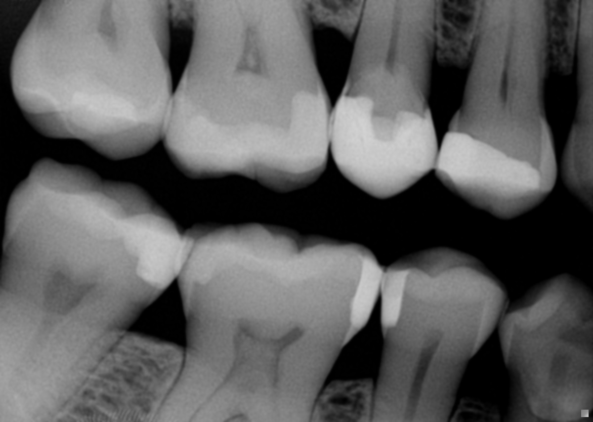 Premolar Composite Onlays and Overlays Premolar Composite Onlays and ...