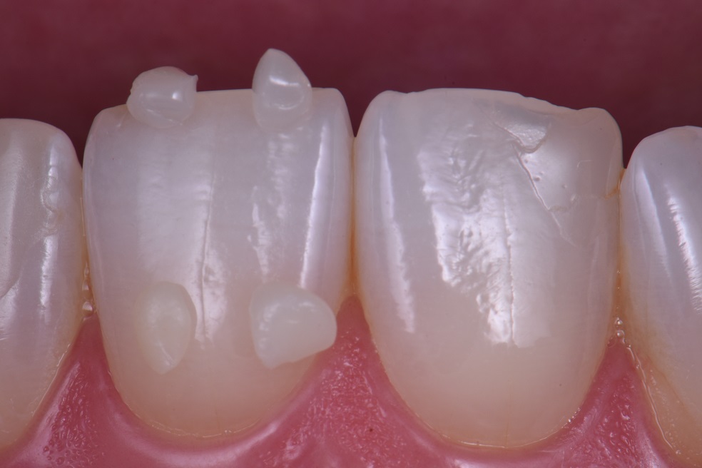 Composite Additions to Derotate Teeth Composite Additions to Derotate Teeth