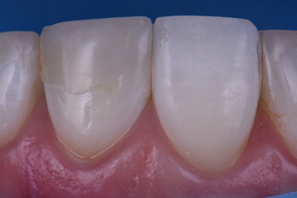 Seamless Anterior Composite Restorations Seamless Anterior Composite ...