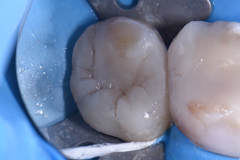 Posterior Amalgam Replacement