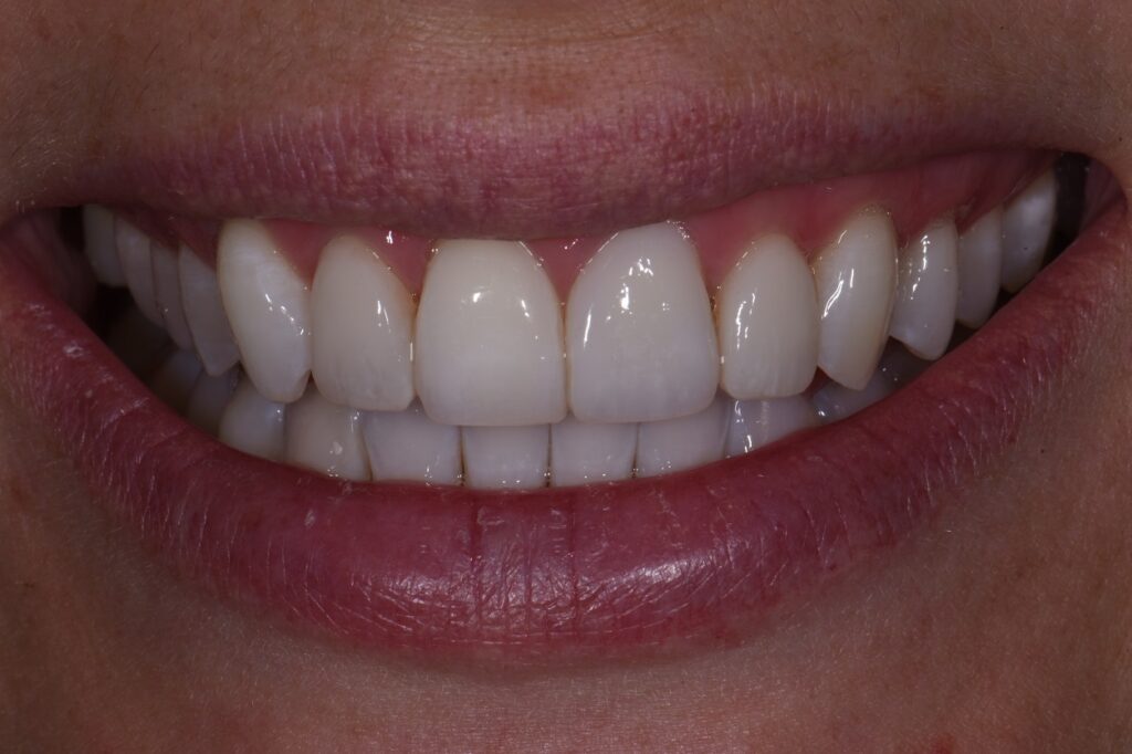 Composite Veneers to Balance Esthetics Composite Veneers to Balance ...