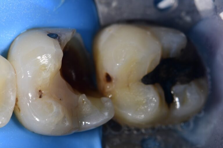 Mesial Drift and Root Proximity Restorations Mesial Drift and Root ...