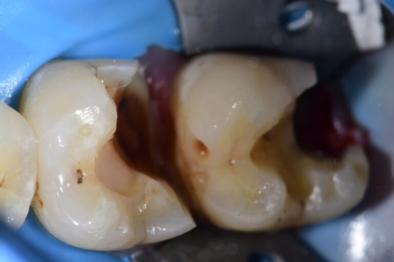 Mesial Drift and Root Proximity Restorations Mesial Drift and Root ...