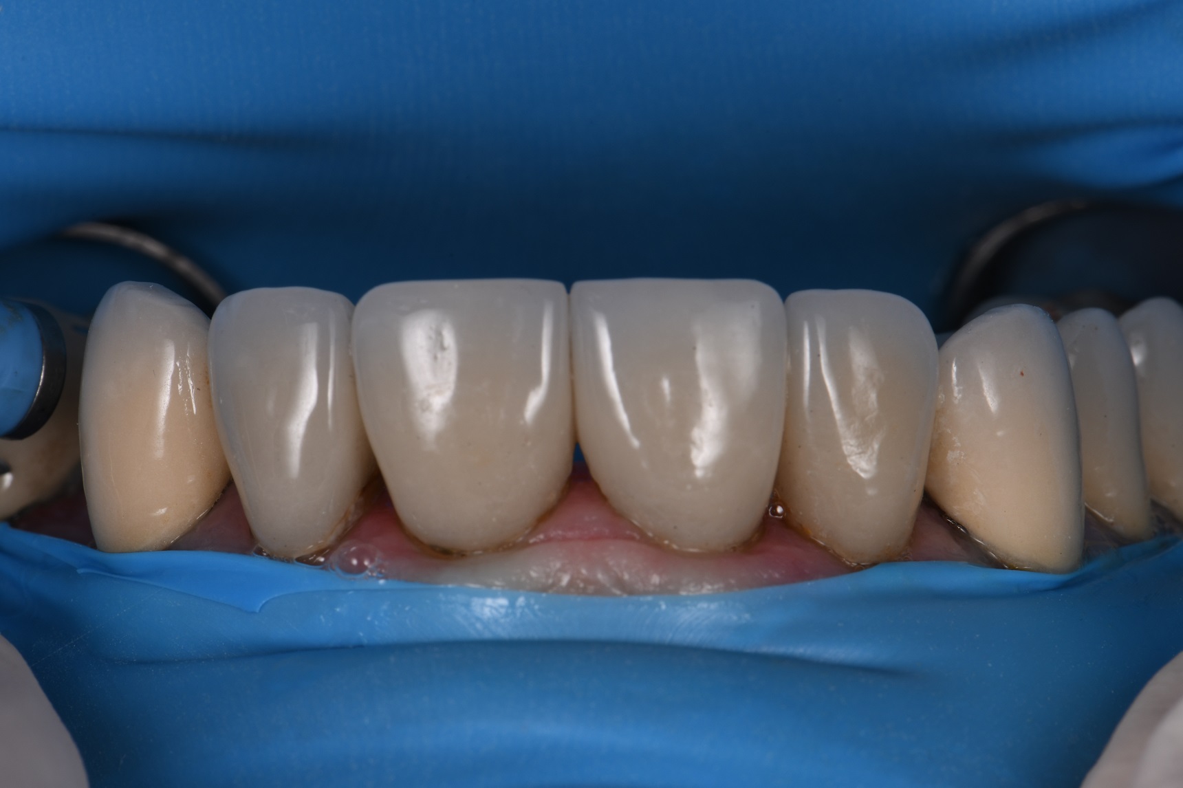 preparations-for-new-bonded-porcelain-crowns-preparations-for-new