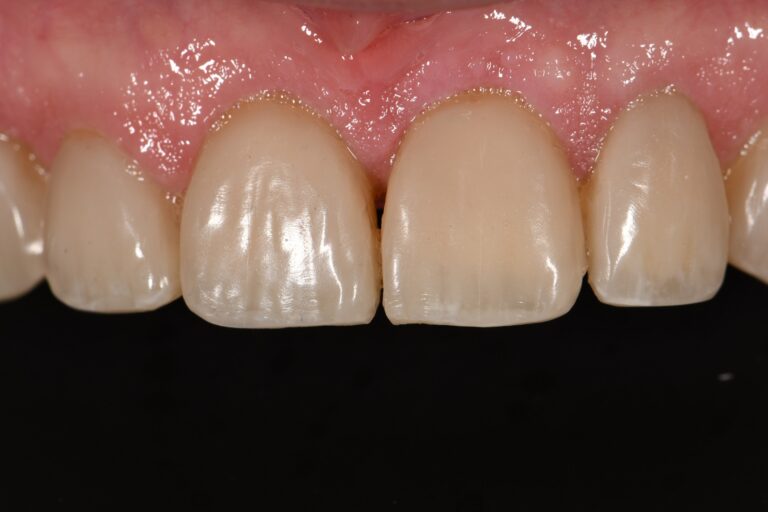 Transitional Bonding | Pre-Prosthetic Orthodontics | Deprogrammer