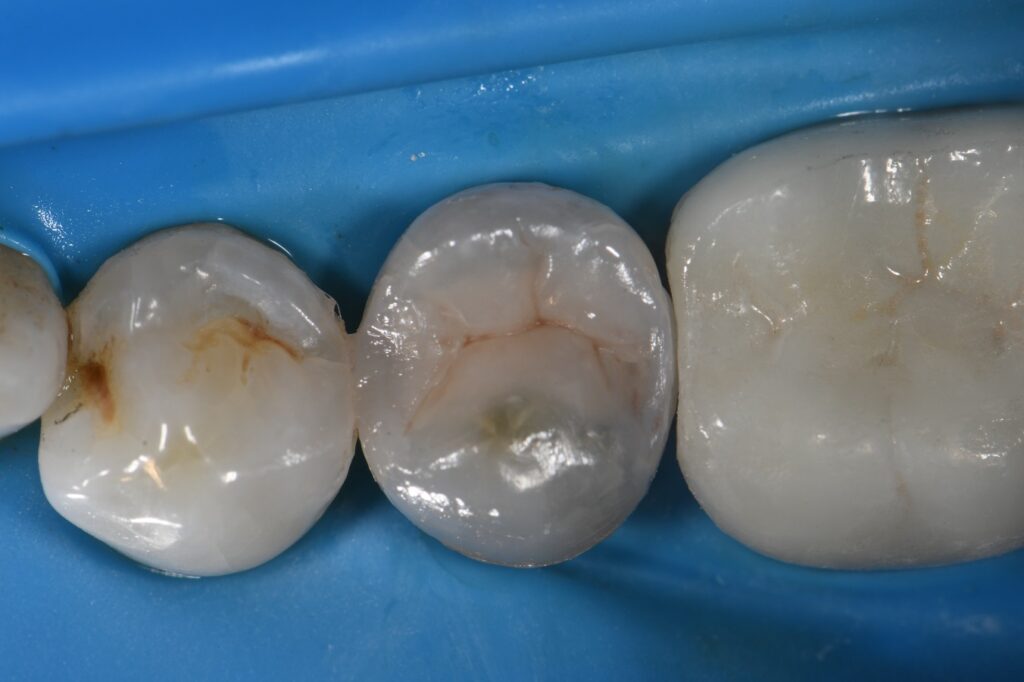 Amalgam Removal and Composite Resin Replacement