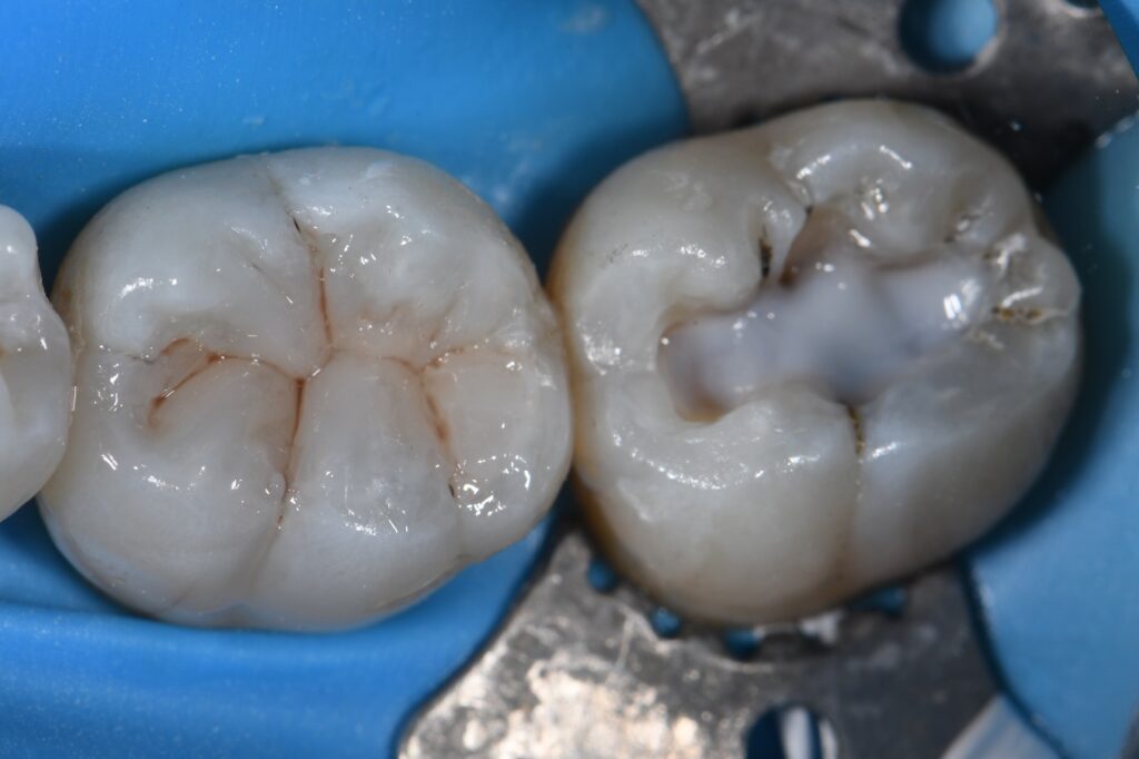 Dental Amalgam Replaced with Invisible Composite Resin