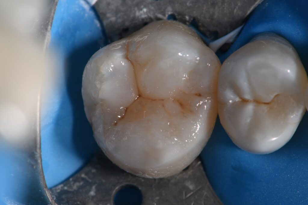 Composite Fillings Marginal Leakage And Failure Composite Fillings Marginal Leakage And Failure