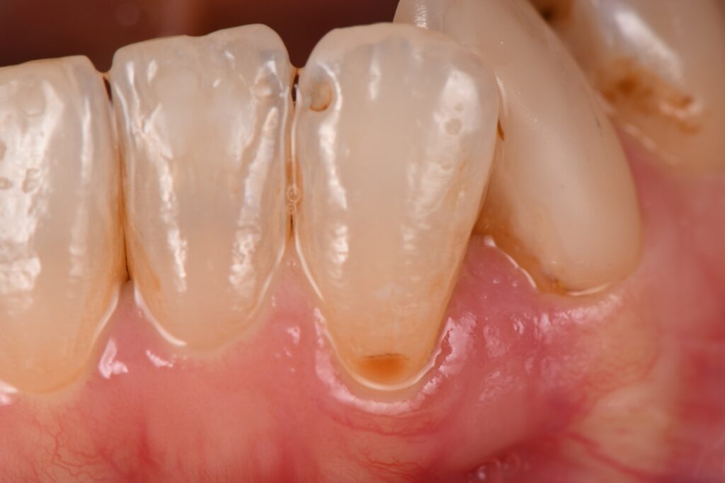 Caries on the root surface restored