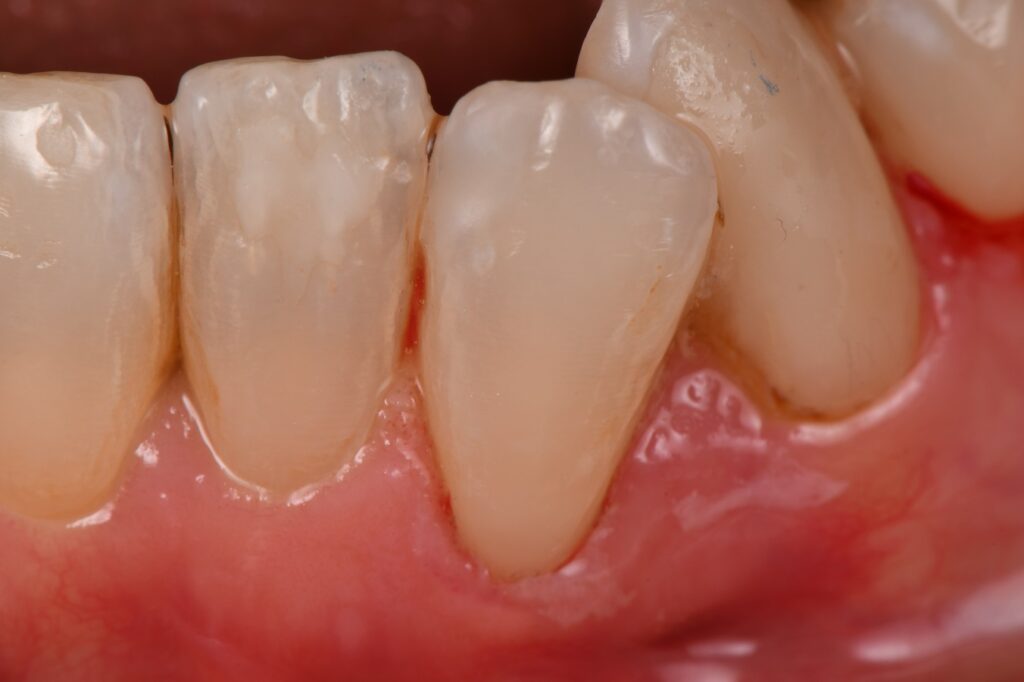 Caries on the root surface restored