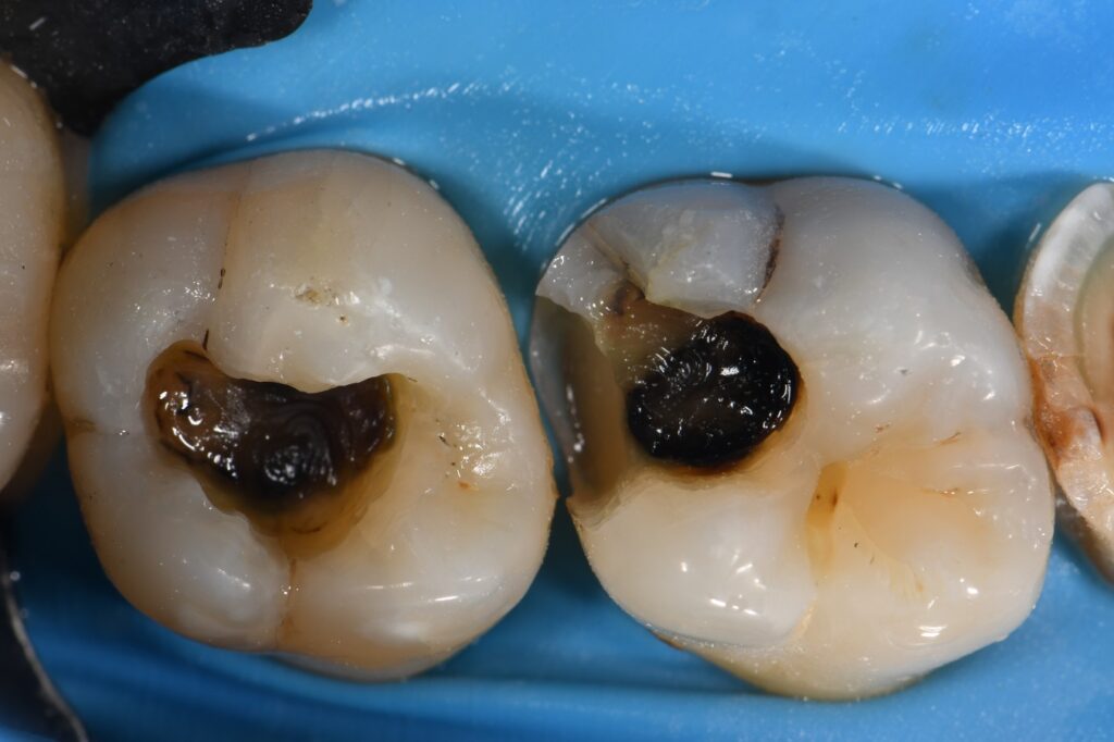 Removing Cracks and Amalgam in Teeth Removing Cracks and Amalgam in Teeth