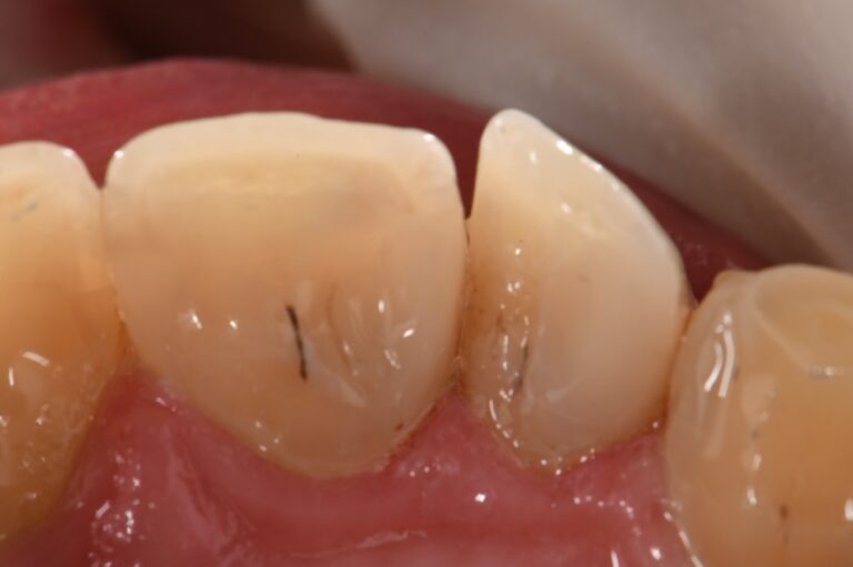 Rampant Caries Breakdown Restored With Composite Resin   CPT 3603 768x511 