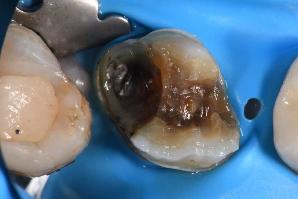 Dental Crown Indirect Restoration Workflow