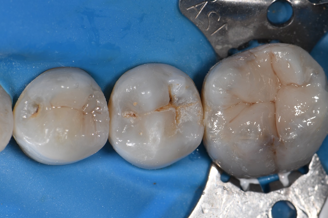 Grey teeth whitened after removal of amalgam