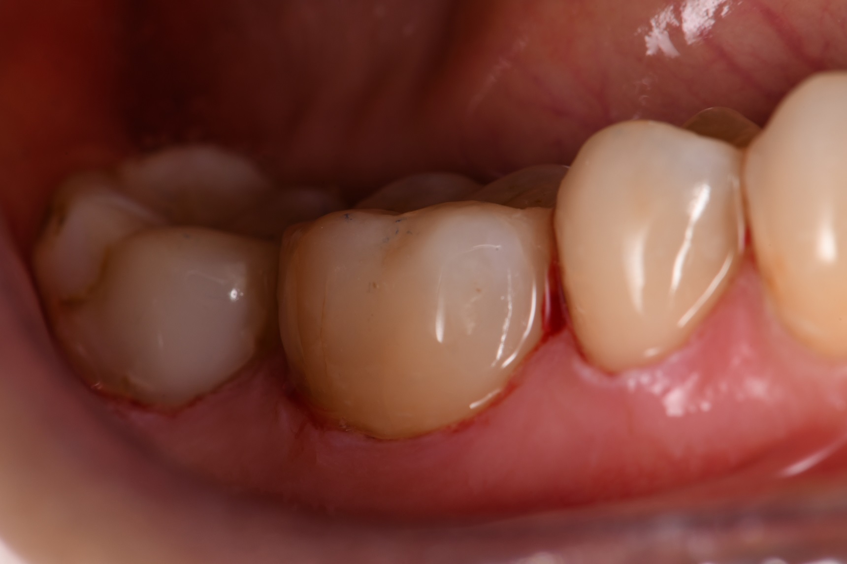 Cervical ringbark caries conservatively restored