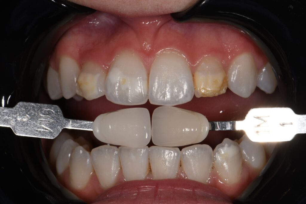 Resin Infiltration and Composite Layering