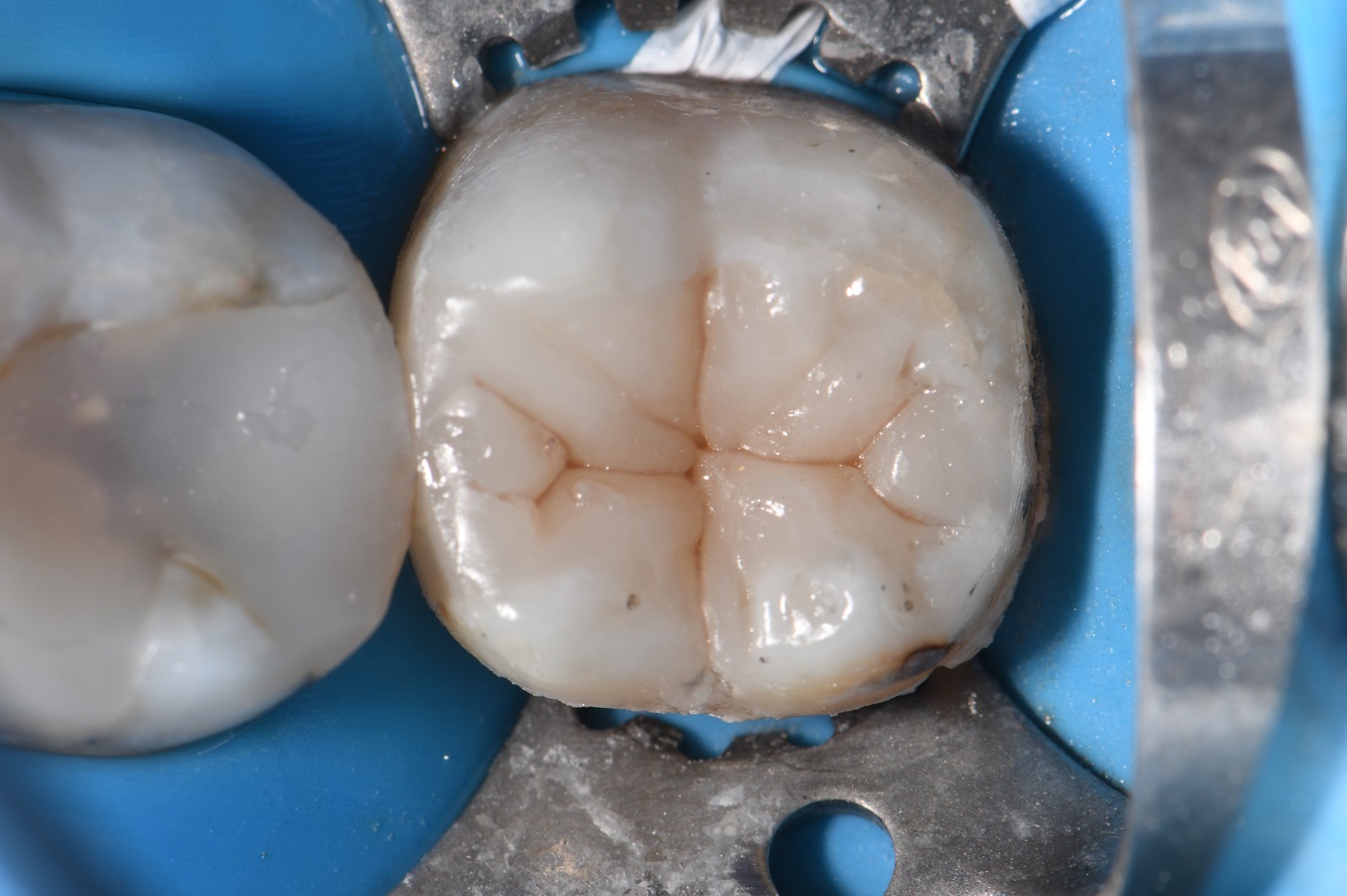 Amalgams Replaced with White Restorations