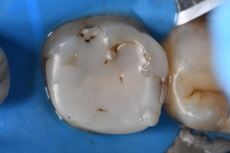 Porcelain Bonded Crowns Auckland