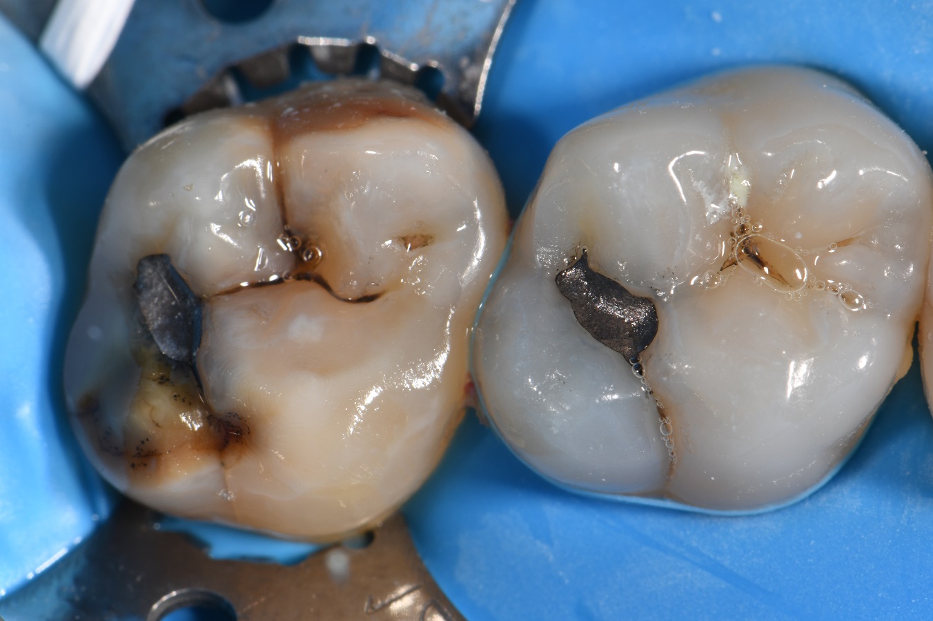 Dental Amalgam Removed along with caries