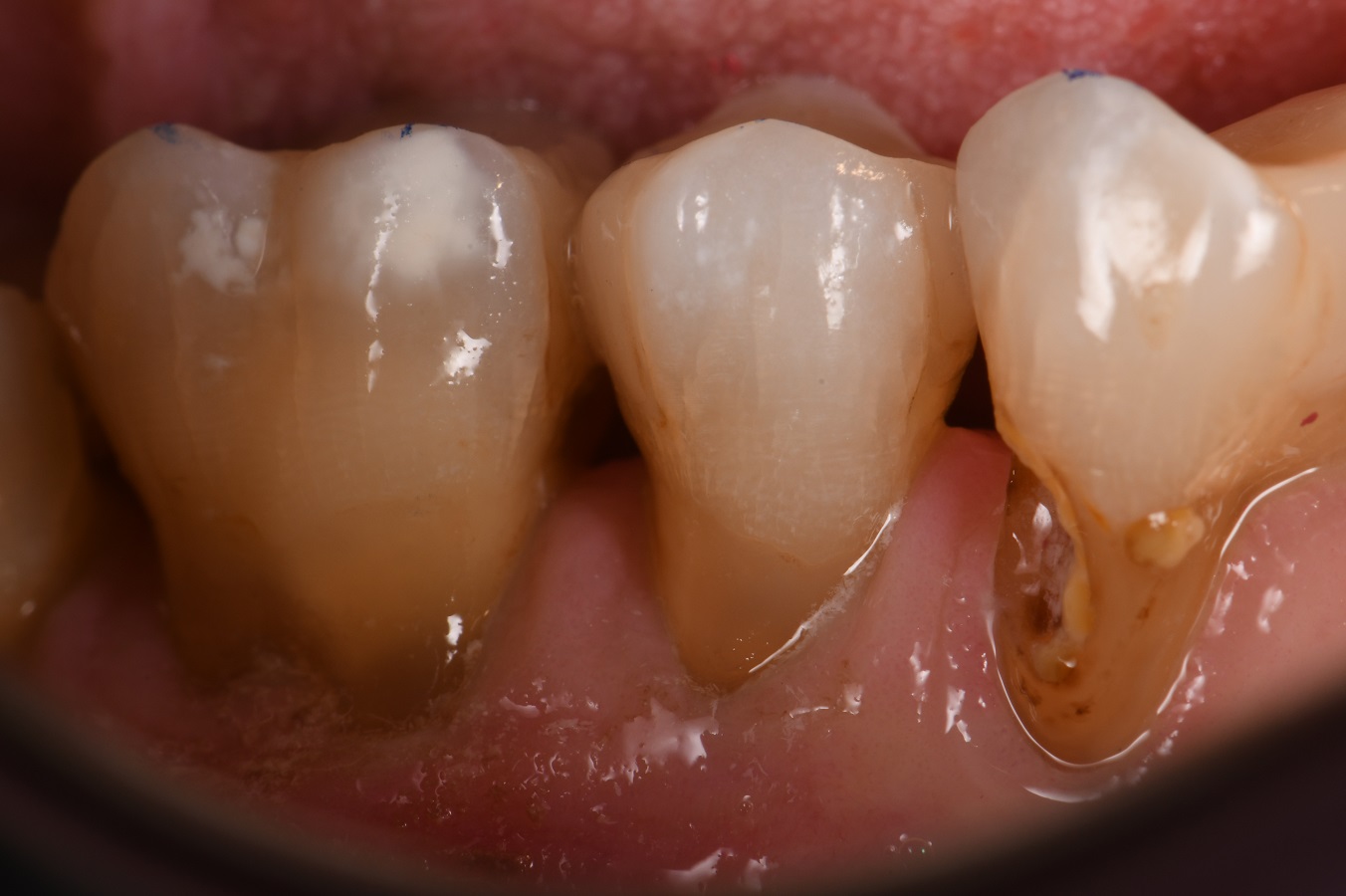 Root caries is a consideration with exposed radicular dentin