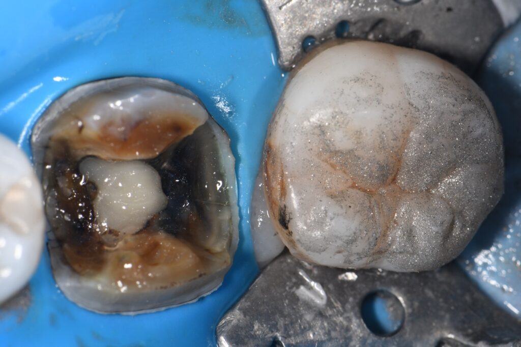 Reconstructing a Broken Down Molar