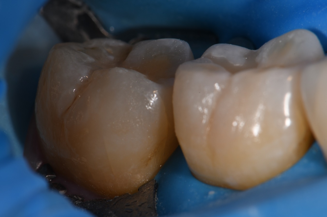 buccal-groove-restoration-using-clearfil-majesty-es-2-universal