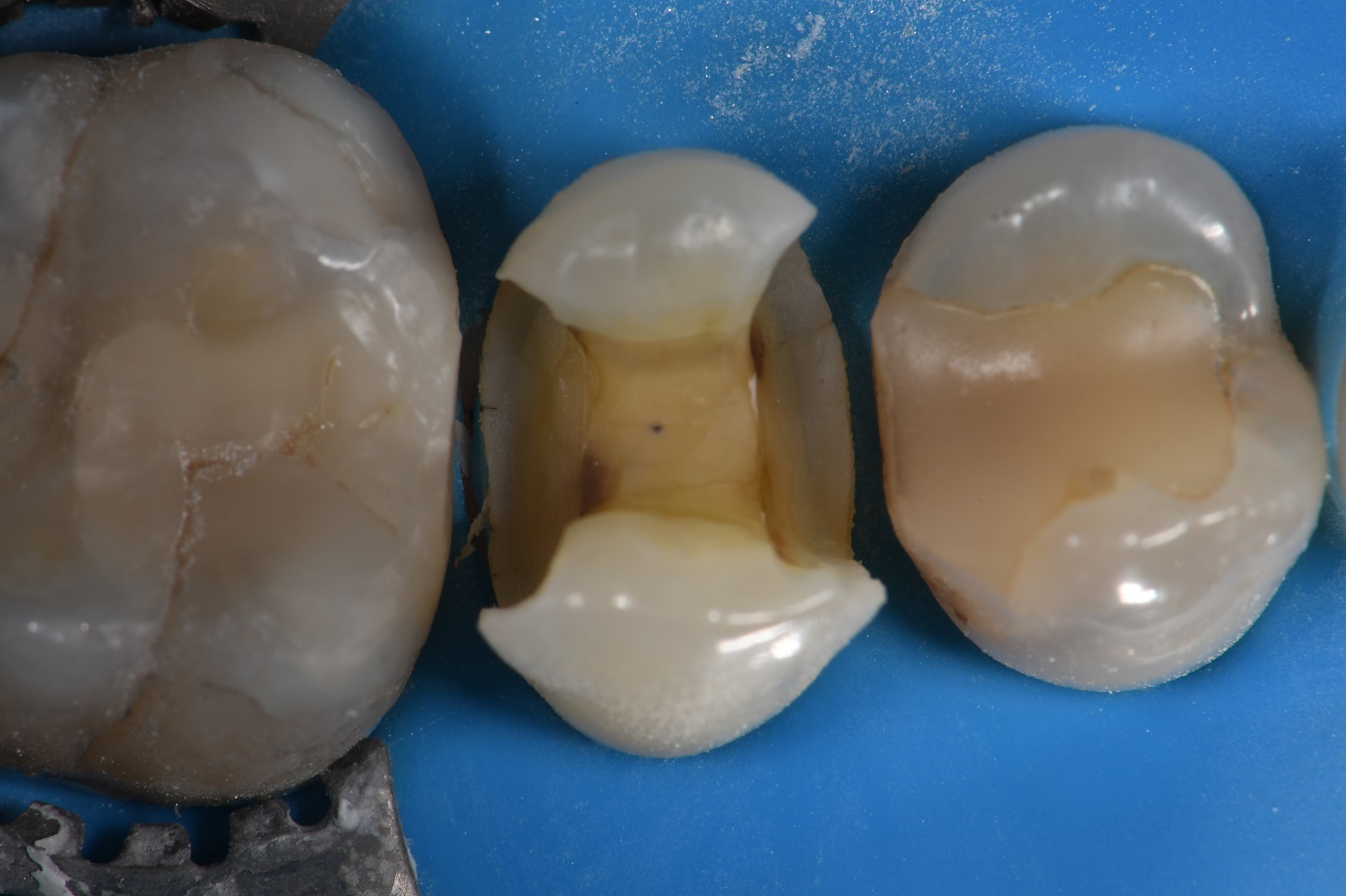 Composite Restorations with Invisibility