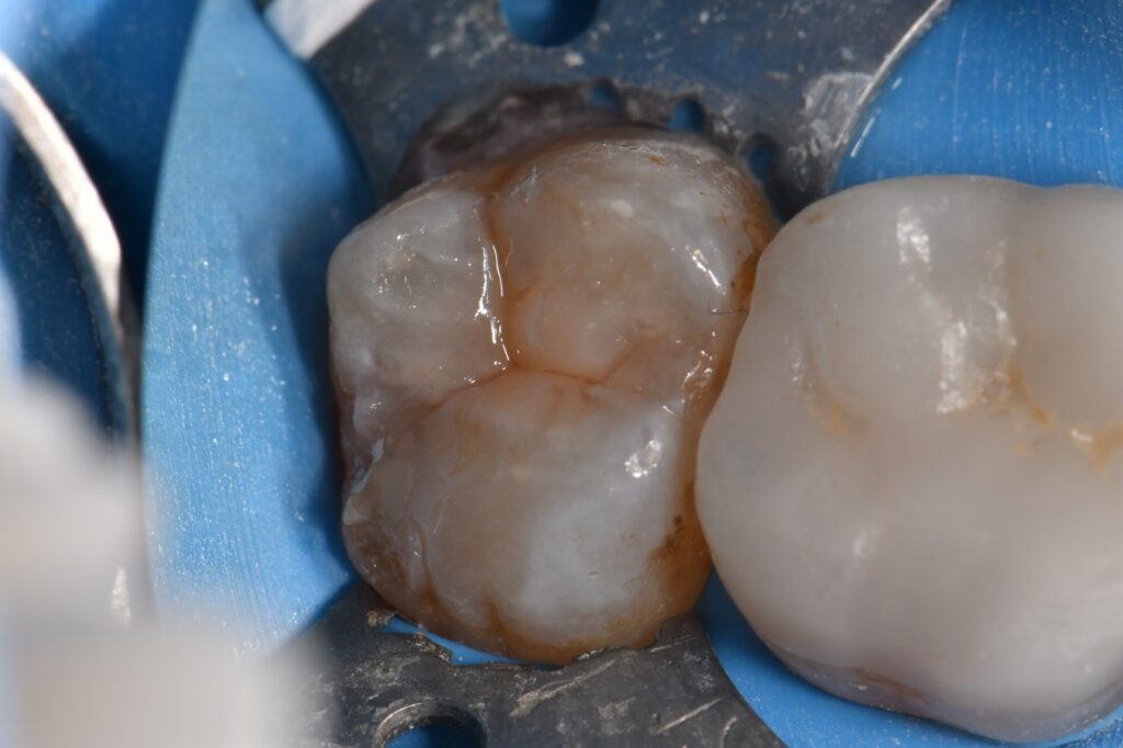 Caries on tooth #15