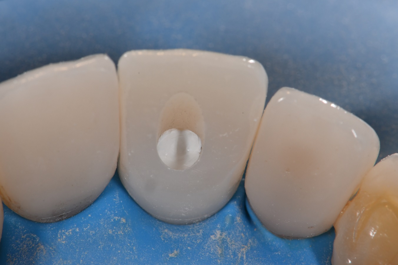 Bonding to Zirconia using Blatz APC technique