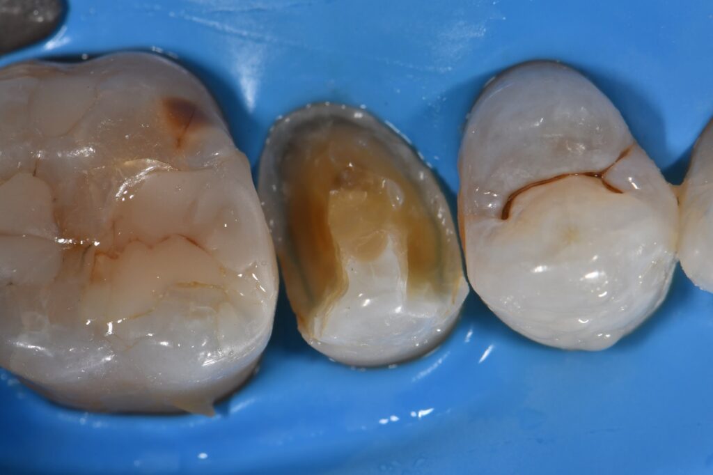 A Biobase strengthens the dentin-resin bond over time