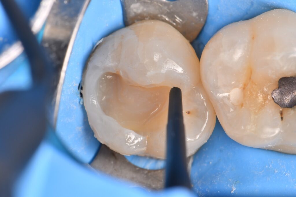 Fracture toughness injection into composite restorations